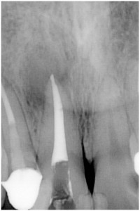 福田２　右上1 根管充填